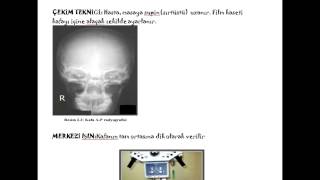 Kafa AP PA ve Lateral radyografisi [upl. by Golding983]