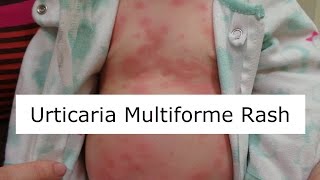 Urticaria Multiforme Rash [upl. by Amadeo]