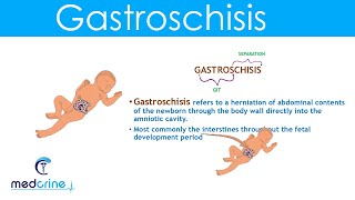 Gastroschisis Definition Causes and Diferences with Omphalocele [upl. by Ayhay258]