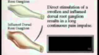 Adhesive Arachnoiditis Stages of Development and Common Cause [upl. by Ally459]