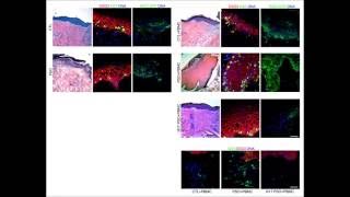 Insight into pathologic epidermalimmune interactions in psoriasis [upl. by Acsisnarf]