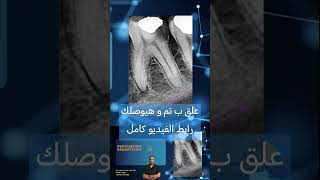 Clinical cases in Endodontics الكربولة endodontics dental [upl. by Adien]