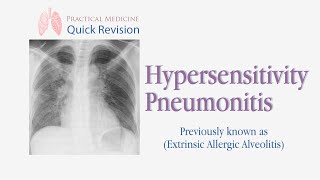 Hypersensitivity Pneumonitis Extrinsic Allergic Alveolitis  EAA [upl. by Terry251]