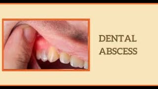 Understanding Dental Abscess Causes Symptoms and Treatment shorts youtubeshorts [upl. by Nations]