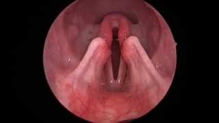 Dog Lar Par Laryngeal paralysis observed in sedated canine oral exam [upl. by Elleda]