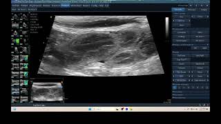 IQ 315 PYOMETRA ULTRASOUND ECHOPAC ANALYSIS UTERUS [upl. by Aliet]