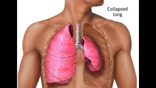 What is Lung Atelectasis Collapse [upl. by Jacobson]