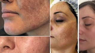 Remove Pigmentation Melasma Freckles Brown Spots Result in One Week [upl. by Yreva]