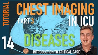 Chest Imaging in ICU  Part 3  Diseases of the Lung in ICU [upl. by Yraht807]