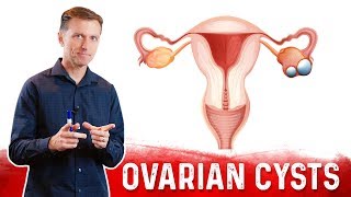 Ovarian Cysts Causes Symptoms amp Natural Treatment – DrBerg [upl. by Thorrlow120]