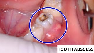 How Do I Know If My Tooth Is Abscessed   How to Identify an Abscessed Tooth  Symptoms and Signs [upl. by Homovec]