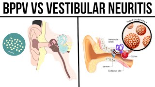 BPPV vs Vestibular Neuritis [upl. by Talbot]