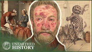 The Gruesome Diseases That Plagued The Medieval World  Medieval Dead  Unearthed History [upl. by Jaynes394]