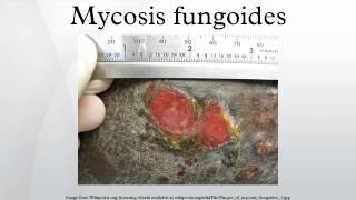 Mycosis fungoides [upl. by Narhem]