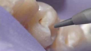 Dental Air Abrasion  Denville NJ [upl. by Anayrb]