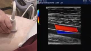 How To Lower Extremity Arterial Duplex Exam [upl. by Tudela]