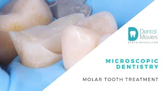 Microscopic dentistry  molar tooth treatment [upl. by Izabel]