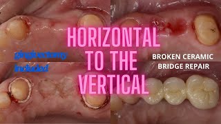 HORIZOTNAL TO THE VERTICAL broken bridge with gingivoplasty [upl. by Mikeb843]