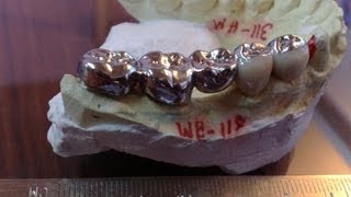 Dental Bridge  What Is Dental Bridge [upl. by Joyann650]