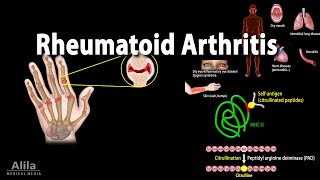 Rheumatoid Arthritis Animation [upl. by Enttirb]