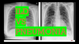 Chest Xray interstitial lung disease vs PneumoniaTypes of opacities in lungs [upl. by Avirt]