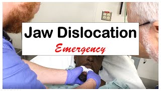 Acute Jaw Dislocation Emergency [upl. by Annoed]