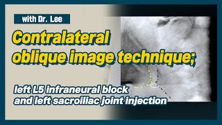 Learn contralateral oblique image Carm anatomy SIJ and infraneural transforaminal injection [upl. by Ayortal959]