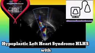 Hypoplastic Left Heart Syndrome HLHS Aiden’s Story [upl. by Tudela]