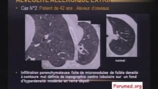 Imagerie des pneumopathies et Fibrose Pulmonaire [upl. by Roybn]