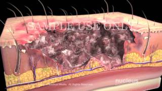 Burns Classification and Treatment [upl. by Alleber]