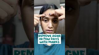 Pimples removal on face at home no side effects acne short shortsfeed shortvideoviral [upl. by Nitsew]