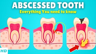 Abscessed Tooth – Causes Signs and Symptoms Diagnosis amp Treatment [upl. by Gemoets180]