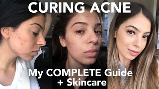 CURING ACNE My COMPLETE Guide  Skincare [upl. by Viridis643]