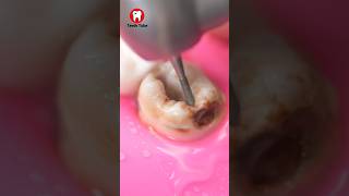 Decayed Tooth Reconstruction faketooth toothfilling toothdecay shorts [upl. by Assiled]