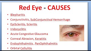 Ophthalmology 167 Acute Red Eye Differential Diagnosis causes Conjunctivitis Uveitis Glaucoma [upl. by Yhtomiht]