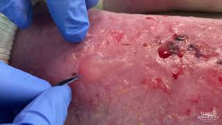 Dermatologist Popping Blisters  CONTOUR DERMATOLOGY [upl. by Turtle]