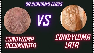 Condyloma Accuminata vs Condyloma Lata  Dermatology  FMGE NEETPG INICET [upl. by Inalak]