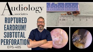 RUPTURED EARDRUM  SUBTOTAL PERFORATION  EP489 [upl. by Nibur151]