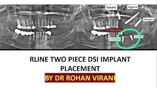 RLINE TWO PIECE DSI IMPLANT PLACEMENT BY DR ROHAN VIRANI [upl. by Enail358]