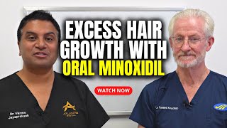 Excess Hair Growth with Oral Minoxidil [upl. by Ennaeilsel278]