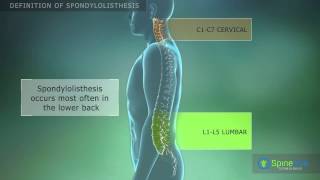 Spondylolisthesis Definition [upl. by Quinn480]