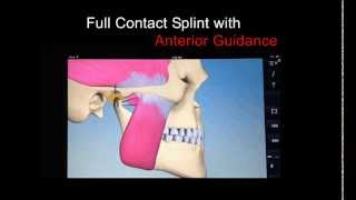 Full Contact Splint with Anterior Guidance – Dr Deborah Ruddell [upl. by Mary]