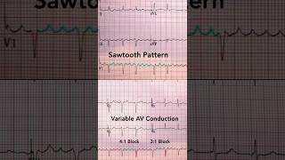 Atrial Flutter ECG [upl. by Kingsly]