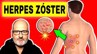 HERPES ZOSTER Culebrilla Síntomas Causas y Tratamiento 🔴 [upl. by Hsoj]