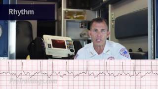 Atrial Fibrillation ECG Rhythm Interpretation [upl. by Uv]