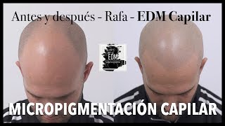 Antes y después en Micropigmentación capilar  Testimonio real del caso de Jose [upl. by Retsev]