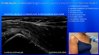 Ultrasound of a Mild Subdeltoid Bursitis with Calcific Bodies in the Overhanging Aspect of the Bursa [upl. by Simmonds]