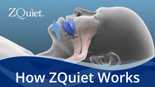 Want to Stop Snoring Learn How ZQuiet Anti Snoring Mouthpieces Work [upl. by Ahsinyt707]