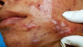 🤮puntos negro en la nariz extracción🔞🤢Black head [upl. by Zahc450]