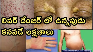 Liver Disease and Symptoms Detailed Video in Telugu [upl. by Ruder]